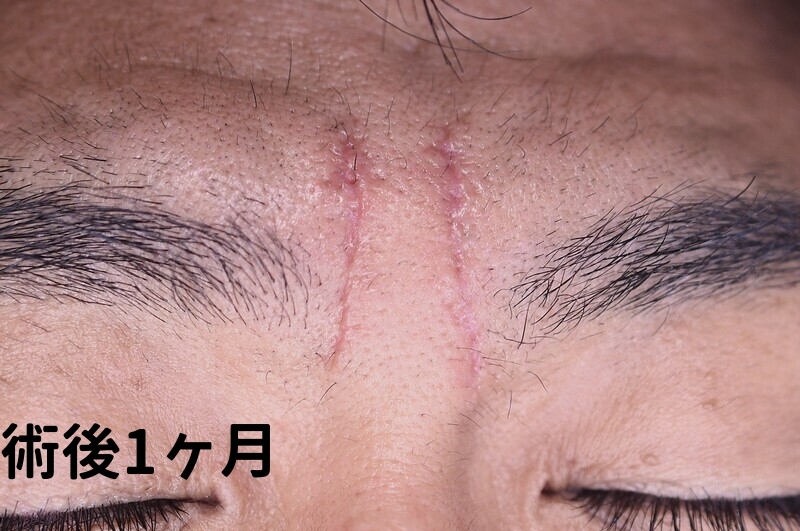 眉間のしわ症例_術後1ヶ月
