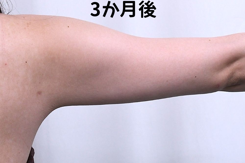 二の腕脂肪吸引術後_3か月
