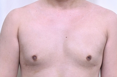 女性化乳房治療_術後1ヶ月正面