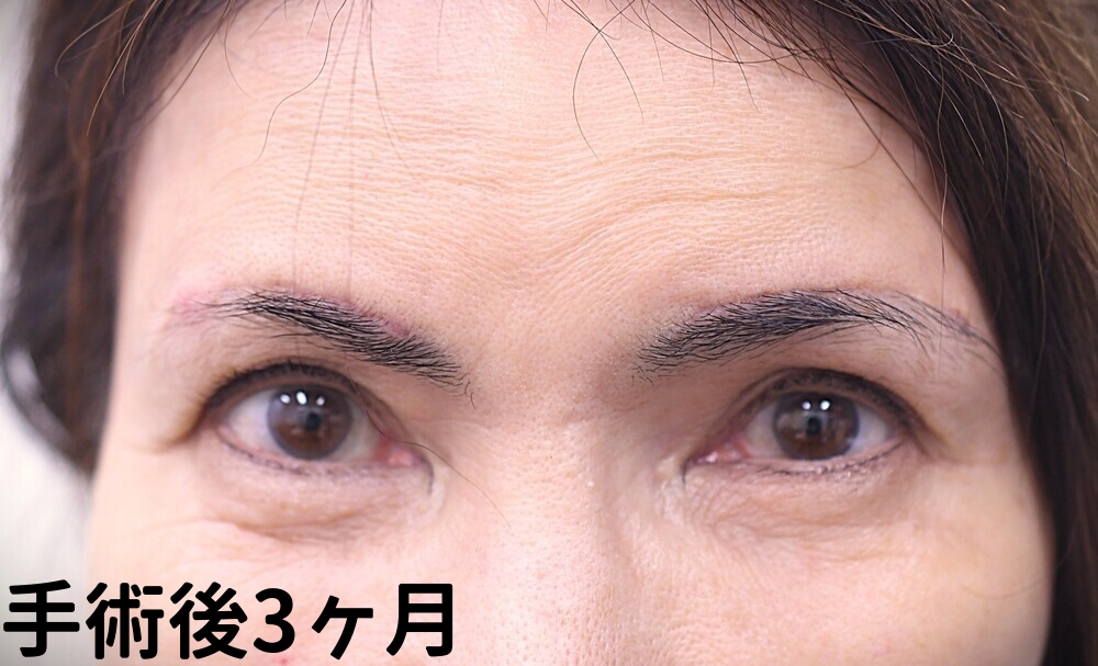 眉上切開症例_手術後3ヶ月