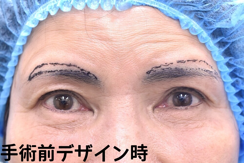 眉上切開症例_手術前デザイン