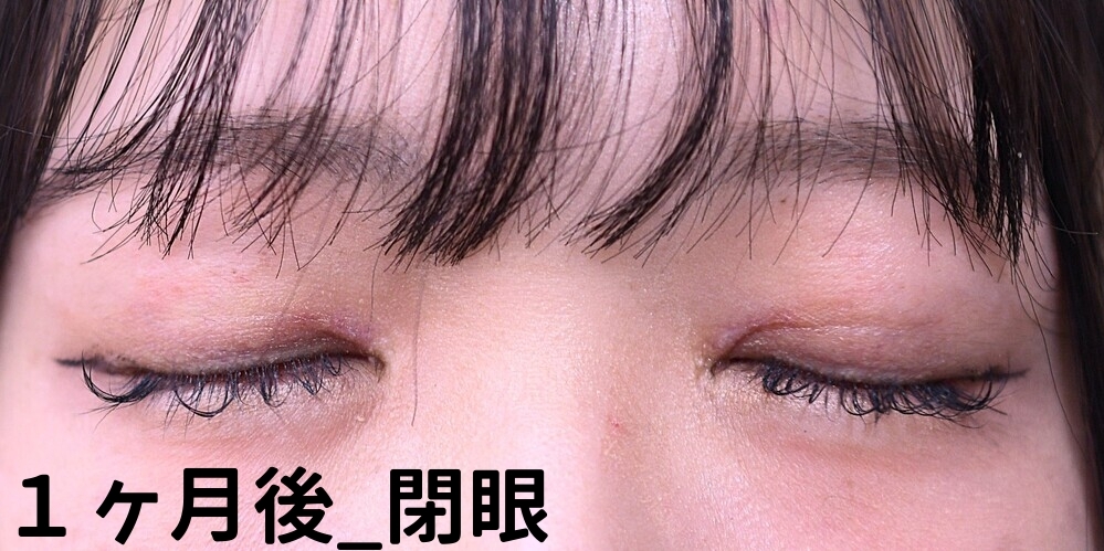 目上切開症例_術後1ヶ月_閉眼