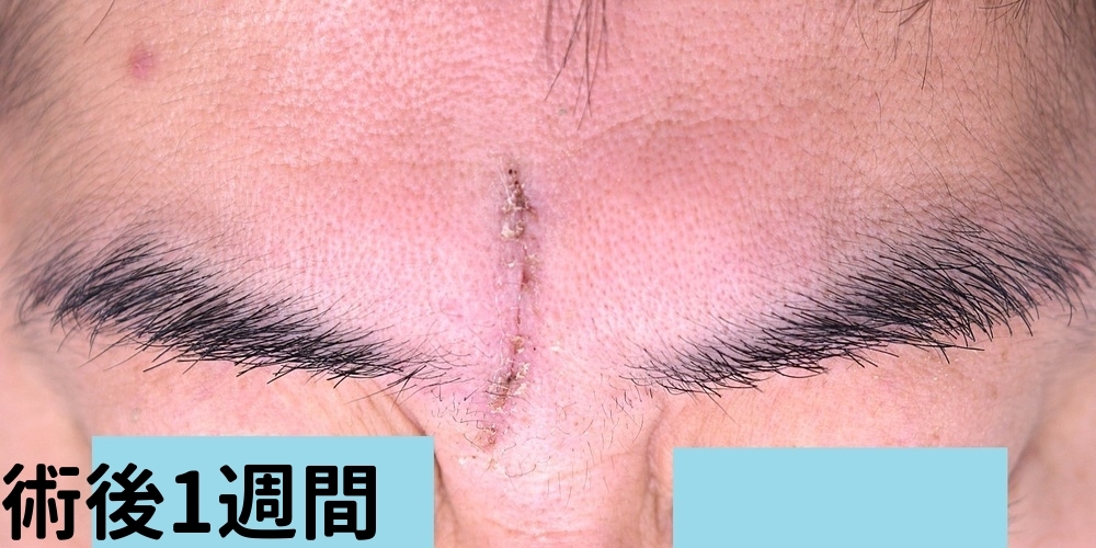 眉間のしわ切除症例_術後1週間