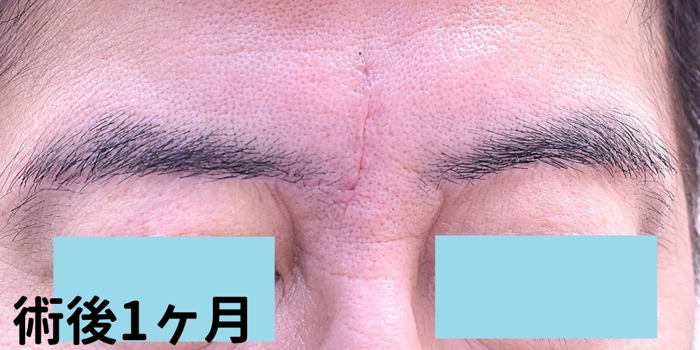 眉間のしわ切除症例_術後1ヶ月