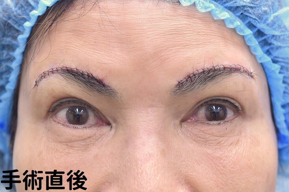 眉上切開症例_手術直後