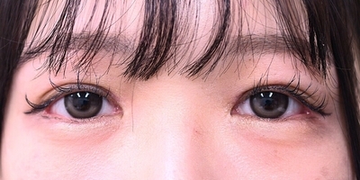 目上切開症例_術後1週間