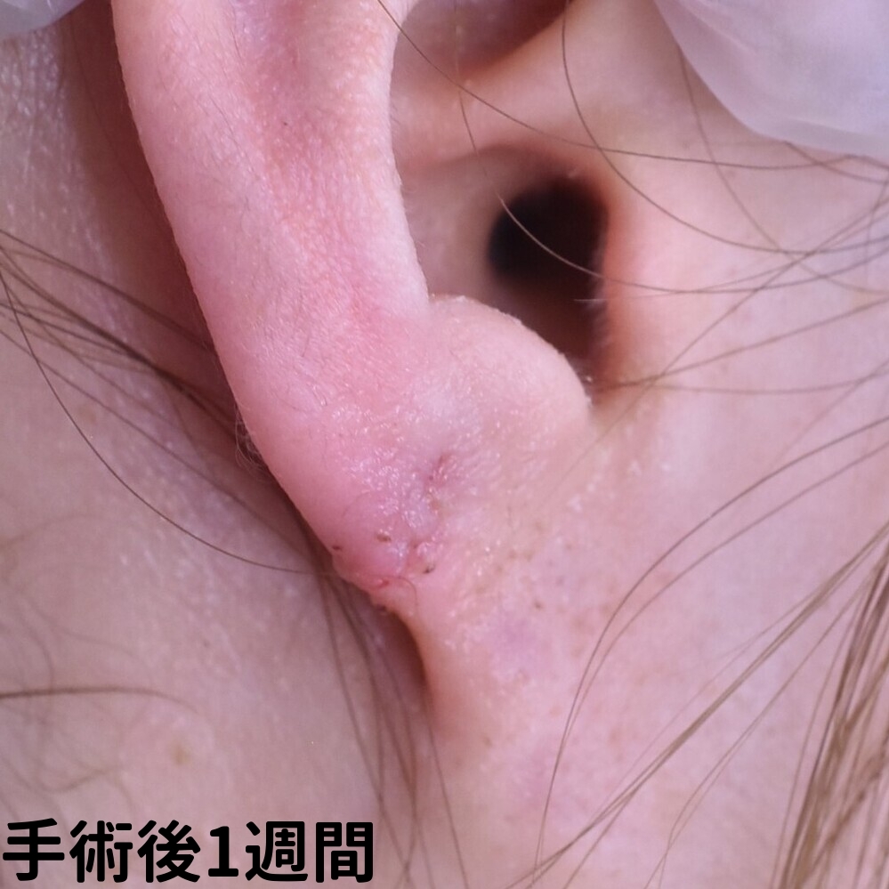耳垂裂症例_手術1週間後