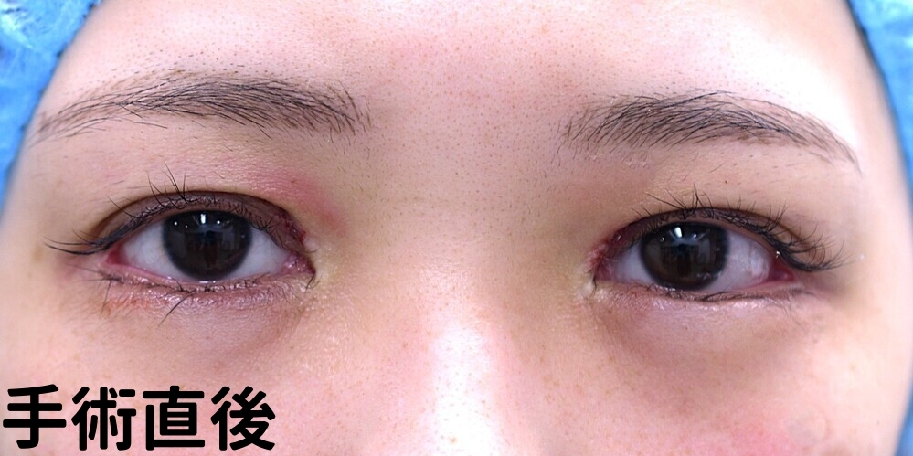 目上切開症例_直後