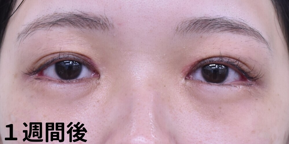 目上切開症例_術後1ヶ月