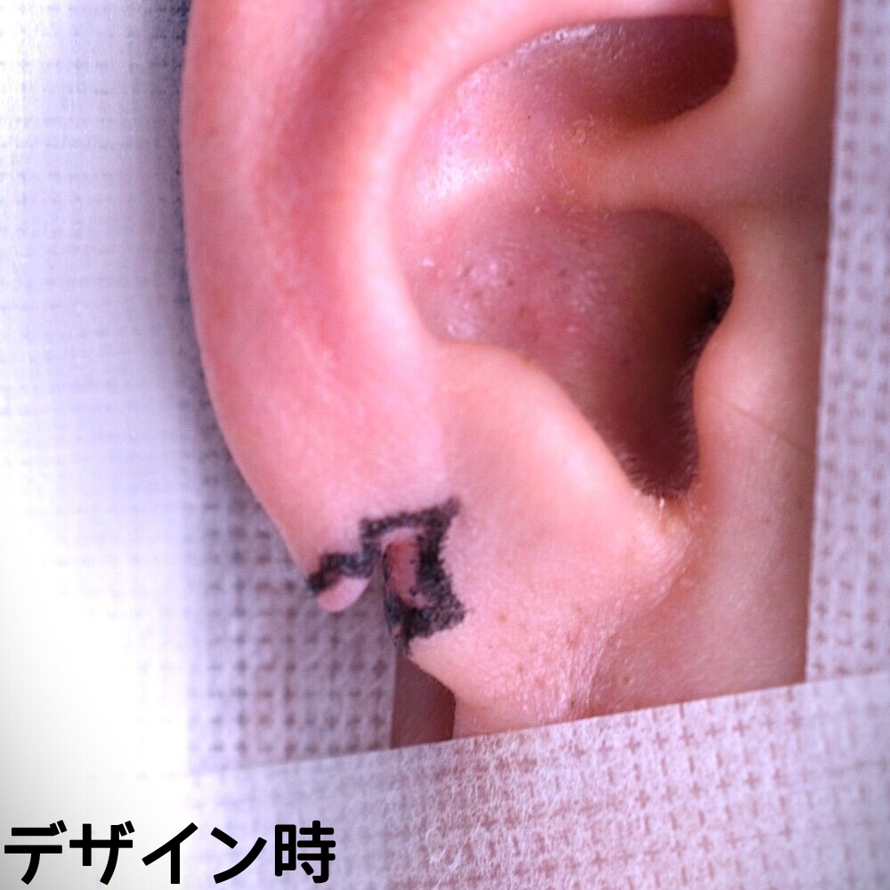 耳垂裂症例_手術前デザイン
