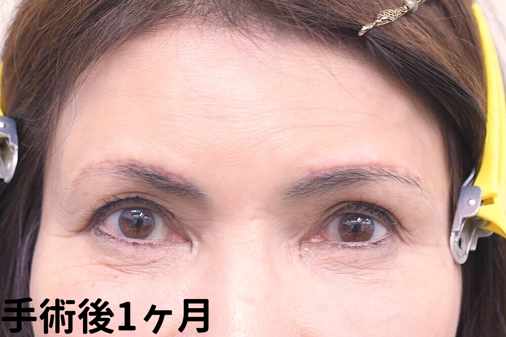 眉上切開症例_手術後1ヶ月
