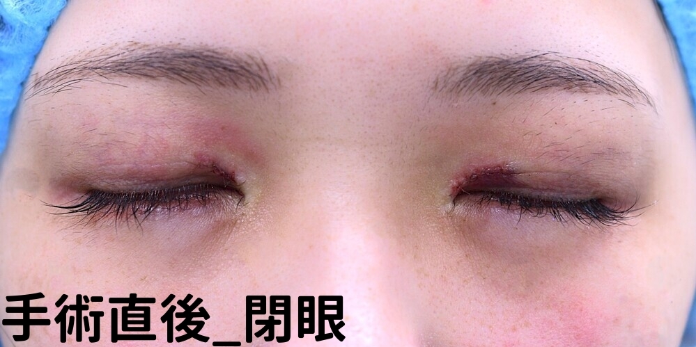 目上切開症例_術後閉眼