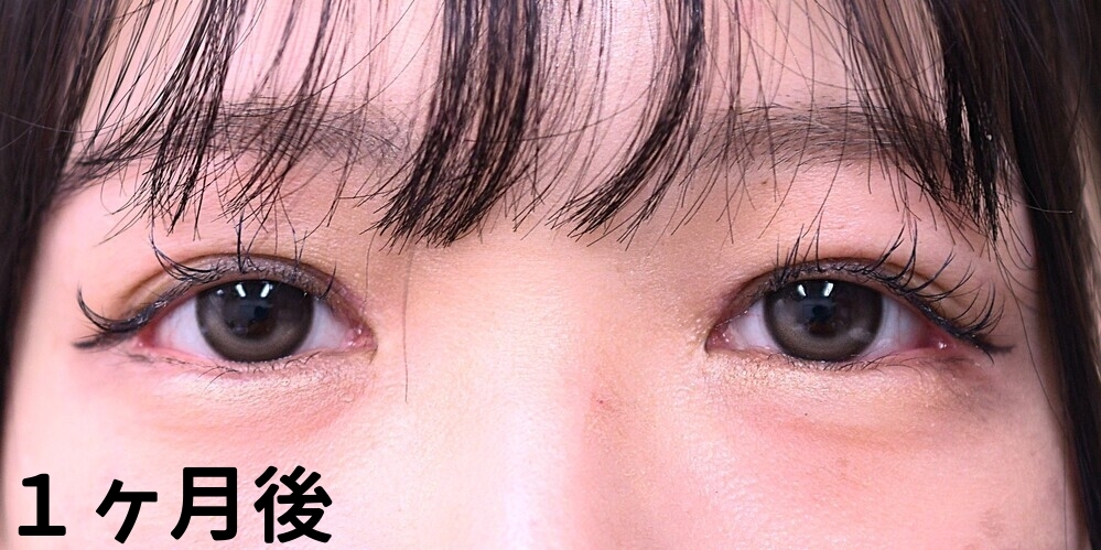 目上切開症例_術後1週間