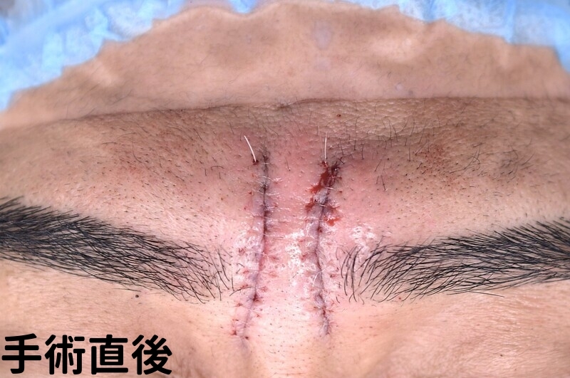 眉間のしわ症例_手術直後